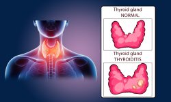 Thyroid Issues
